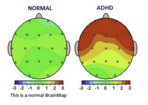 adhd_normal_vs_clinical